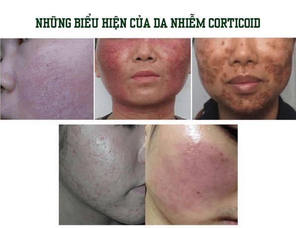 Những hậu quả khi sử dụng sản phẩm có chứa corticoid