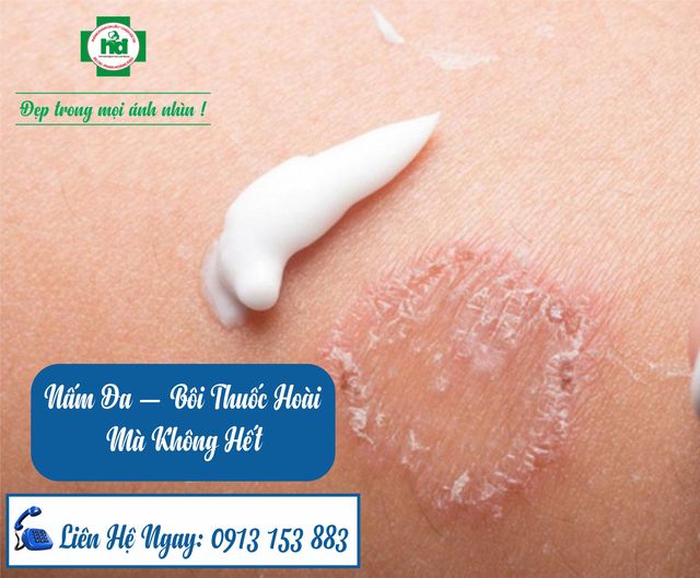 Nấm da - tại sao bôi thuốc hoài không hết?