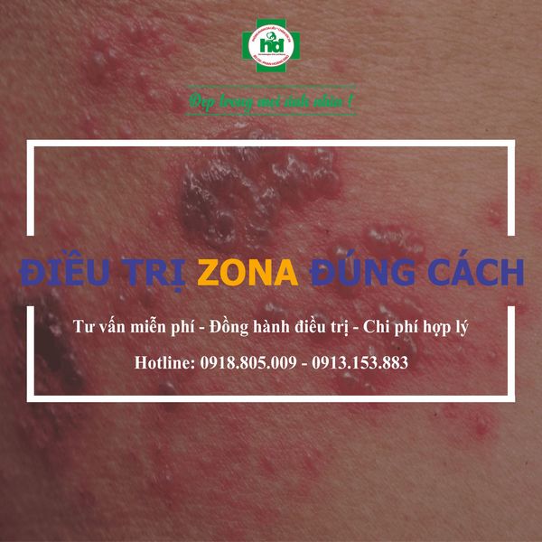 Bệnh zona là gì? nguyên nhân, biểu hiện và cách điều trị