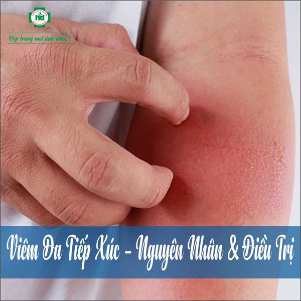 Không nên chủ quan với bệnh viêm da tiếp xúc với côn trùng