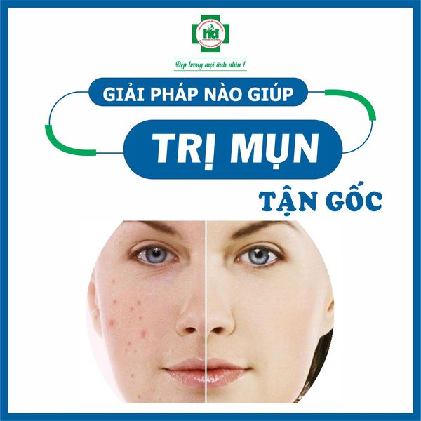 Trị mụn với công nghệ ipl hàn quốc “siêu an toàn”